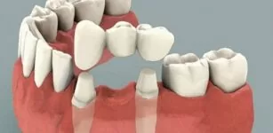 Альтернатива имплантации зубов