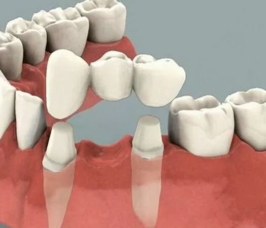 Альтернатива имплантации зубов